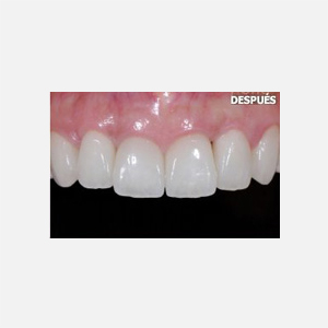 Porcelain veneers after aggressive periodontitis healing|Clínica Dental Ortoperio