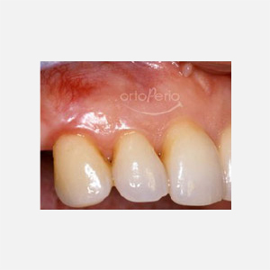 Exposed canine root|Clínica Dental Ortoperio