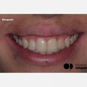 Aesthetic Orthodontics|Clínica Dental Ortoperio