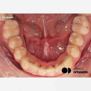 Invisalign orthodontics and connective tissue graft. Severe overcrowding|Clínica Dental Ortoperio