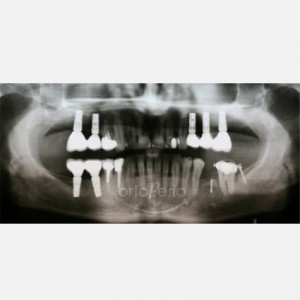 Elevación de Seno|Clínica Dental Ortoperio