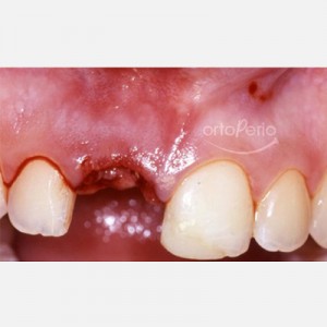 Extracción de diente necrótico y colocación de implante y corona inmediata|Clínica Dental Ortoperio