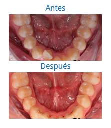 Orthodontics|Clínica Dental Ortoperio
