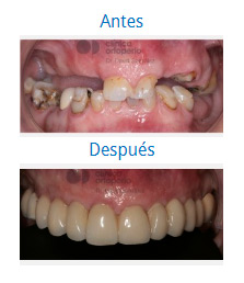 Implantes|Clínica Dental Ortoperio