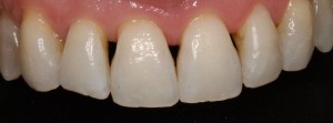 Closure of black triangles in upper incisors with composite veneers|Clínica Dental Ortoperio