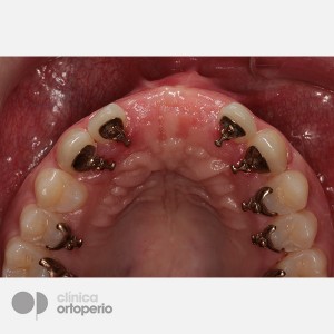 Lingual Orthodontics + Bone graft + Dental Implants + Zirconium crowns- Porcelain|Clínica Dental Ortoperio