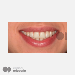 Ortodoncia Lingual. Apiñamiento|Clínica Dental Ortoperio