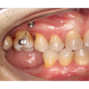 Molar intrusion with micro-implants, without orthodontic appliances|Clínica Dental Ortoperio