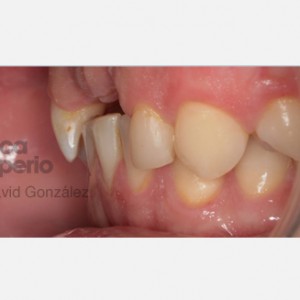 I do not have enough bone for implants|Clínica Dental Ortoperio