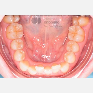 Ortodoncia Adultos, Ortodoncia lingual. Mordida cruzada anterior y apiñamiento|Clínica Dental Ortoperio