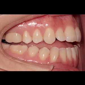 Lingual Orthodontics. Treatment of complex malocclusion class III and open bite in adult patient|Clínica Dental Ortoperio