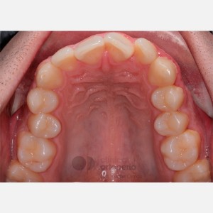 Apiñamiento severo. Ortodoncia Lingual sin extracciones. Stripping|Clínica Dental Ortoperio