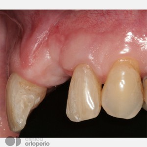 Atrofia ósea: injerto óseo + implante|Clínica Dental Ortoperio