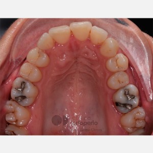 Lingual Orthodontics. Impacted canine. Asymmetric extraction in the lower arch|Clínica Dental Ortoperio