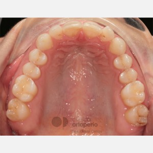Ortodoncia Lingual: Exceso de sobremordida, sonrisa gingival y apiñamiento leve superior|Clínica Dental Ortoperio