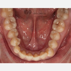 Lingual Orthodontics. Impacted canines. Multidisciplinary case: Orthodontic treatment and Implants|Clínica Dental Ortoperio