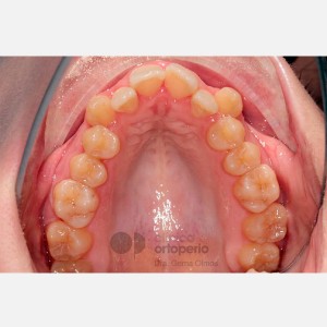 Lingual Orthodontics. Class III, open bite, severe overcrowding, extractions. 3