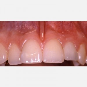 Agenesia (falta congénita de un diente)|Clínica Dental Ortoperio