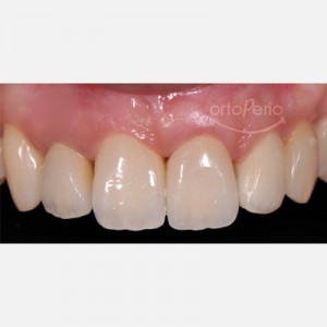 Orthodontic extrusion to regenerate papillae + Immediate implants + Aesthetic prosthesis|Clínica Dental Ortoperio