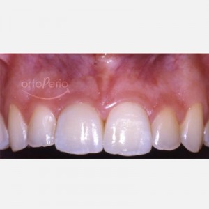 Removal of a necrotic tooth and placement of an implant and an immediate crown|Clínica Dental Ortoperio
