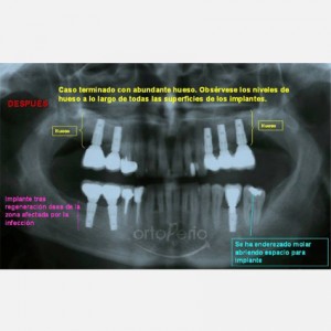 Sinus lift|Clínica Dental Ortoperio