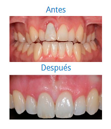 Implants|Clínica Dental Ortoperio