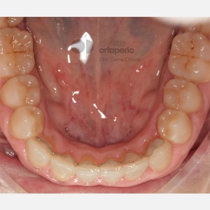 Orthodontics for adults. Lingual Orthodontics. Anterior crossbite and overcrowding|Clínica Dental Ortoperio