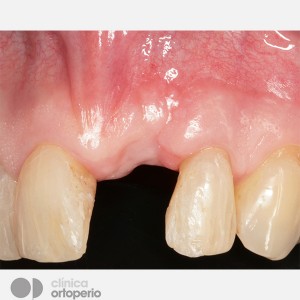 Severe bone and gum loss: Bone graft+ Implant|Clínica Dental Ortoperio