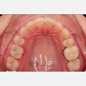 Ortodoncia lingual. Extracción 2 premolares. Tratamiento sólo de la arcada superior|Clínica Dental Ortoperio