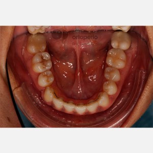 Ortodoncia Lingual. Caninos Incluidos. Caso Multidisciplinar: Ortodoncia e Implantes|Clínica Dental Ortoperio