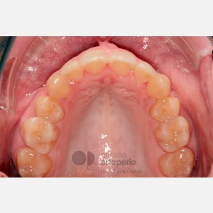 Lingual Orthodontics. Class III, open bite, severe overcrowding, extractions. 4