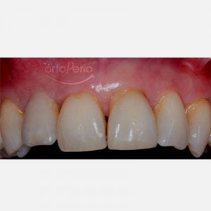 Bone graft+ implant (lateral incisor lost due to periodontitis)|Clínica Dental Ortoperio