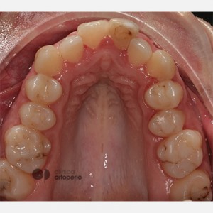 Corticotomy + Lingual Orthodontics + Post-extraction immediate implant|Clínica Dental Ortoperio