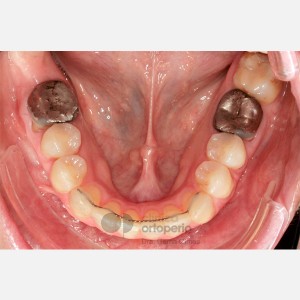 Lingual Orthodontics. Open bite, severe overcrowding. Gum graft|Clínica Dental Ortoperio