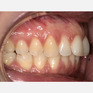 Lingual Orthodontics. Overcrowding|Clínica Dental Ortoperio