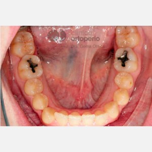 Lingual Orthodontics. Class III, open bite, severe overcrowding, extractions. 5