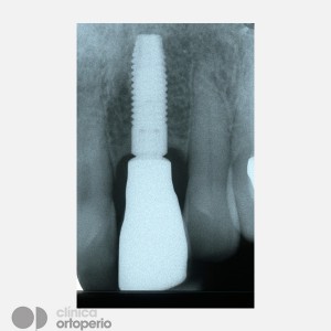 Severe bone and gum loss: Bone graft+ Implant|Clínica Dental Ortoperio