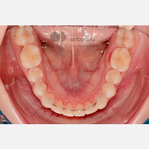 Lingual Orthodontics. Overbite excess, gingival smile, mild upper overcrowding|Clínica Dental Ortoperio