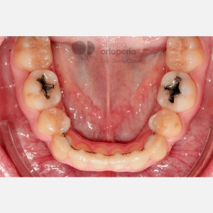 Lingual Orthodontics. Class III, open bite, severe overcrowding, extractions. 6