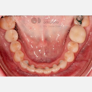 Lingual Orthodontics. Multidisciplinary case: Orthodontic treatment and Implants. Class II/2. Deep overbite|Clínica Dental Ortoperio