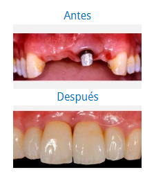 Implantes|Clínica Dental Ortoperio