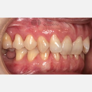 Lingual Orthodontics. Multidisciplinary case: Orthodontic treatment and Implants. Class II/2. Deep overbite|Clínica Dental Ortoperio