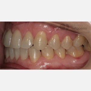 Orthodontics for adults. Lingual Orthodontics. Anterior crossbite and overcrowding|Clínica Dental Ortoperio