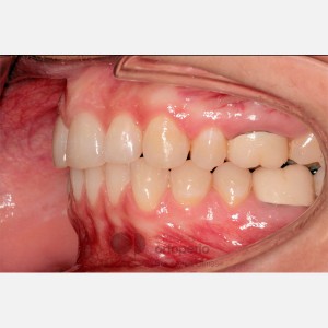 Ortodoncia lingual. Extracción 2 premolares. Tratamiento sólo de la arcada superior|Clínica Dental Ortoperio
