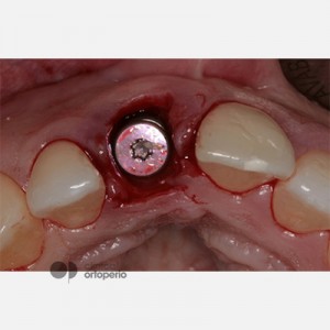 Corticotomy + Lingual Orthodontics + Post-extraction immediate implant|Clínica Dental Ortoperio