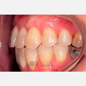 Ortodoncia Lingual. Mordida abierta, apiñamiento severo. Injerto encía|Clínica Dental Ortoperio