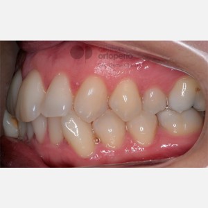 Ortodoncia lingual. Canino Incluido. Extracción Asimétrica en la arcada inferior|Clínica Dental Ortoperio