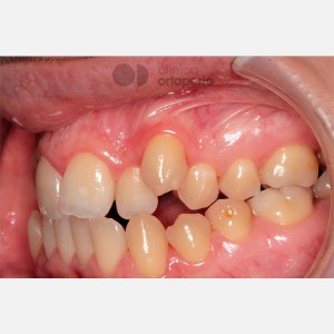 Lingual Orthodontics. Class III, open bite, severe overcrowding, extractions. 9