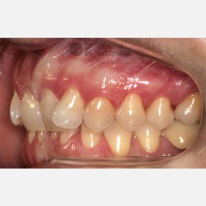 Ortodoncia Lingual. Caso Multidisciplinar: Ortodoncia e Implantes. Clase II/2. Sobremordida profunda|Clínica Dental Ortoperio