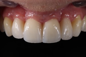 Porcelain veneers to solve black triangles caused by bone and gum loss due to periodontal disease|Clínica Dental Ortoperio